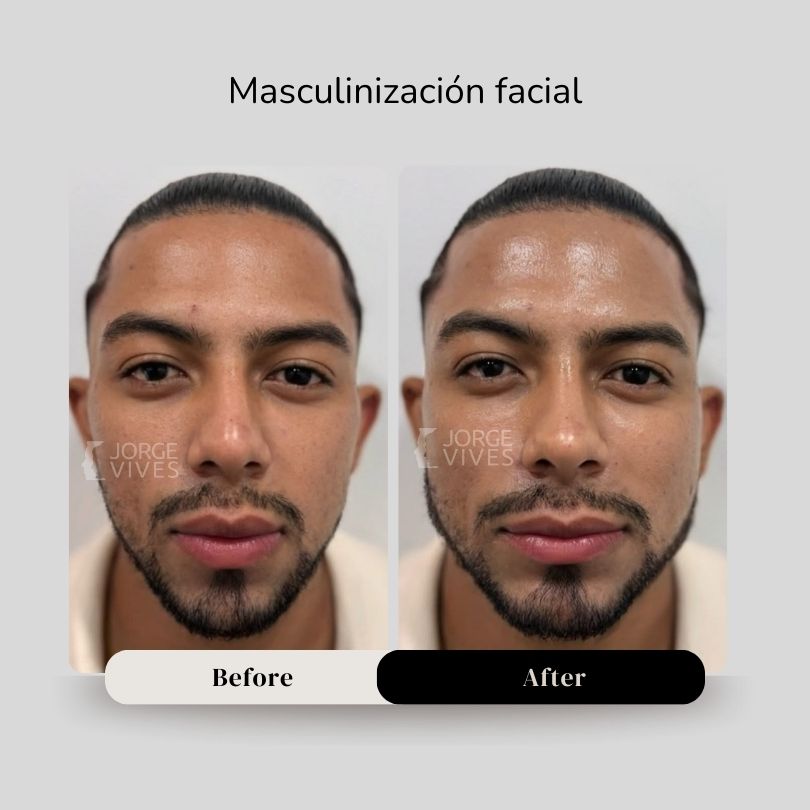 Masculinización facial en Cartagena - Armonización facial
