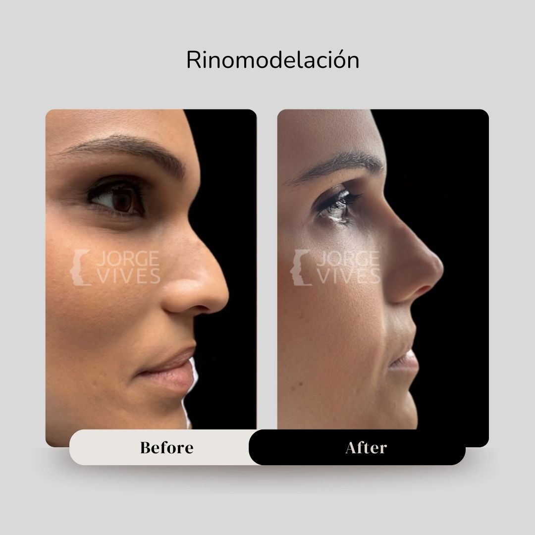RINOMODELACION CARTAGENA