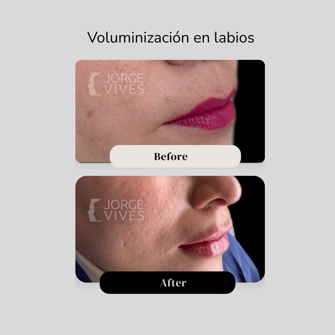 Voluminización de labios en Cartagena