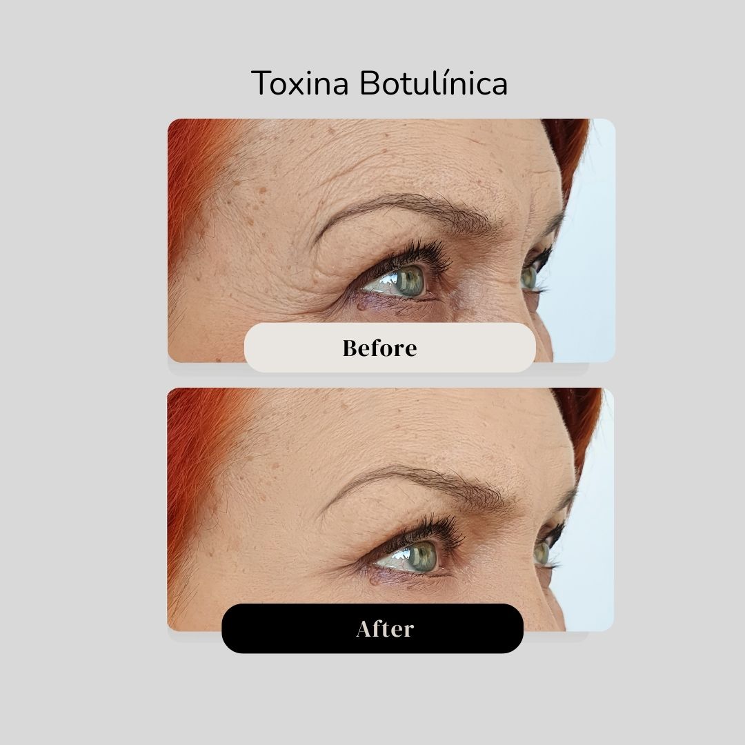 Toxina Botulínica Cartagena