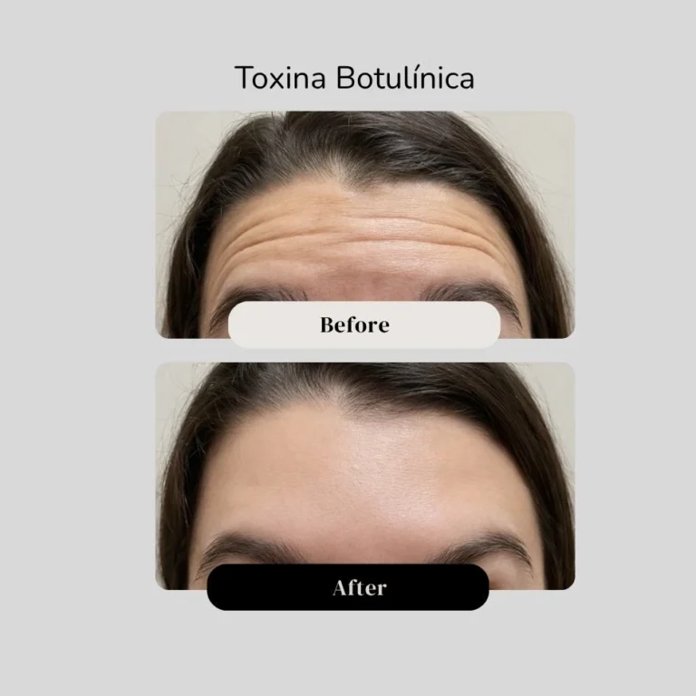 Antes y después de la toxina botulínica - dr. Jorge Vives en Cartagena