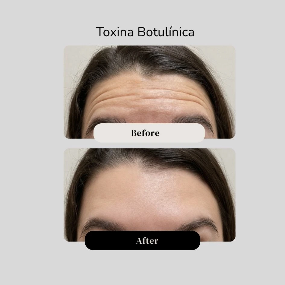 Antes y después de la toxina botulínica - dr. Jorge Vives en Cartagena