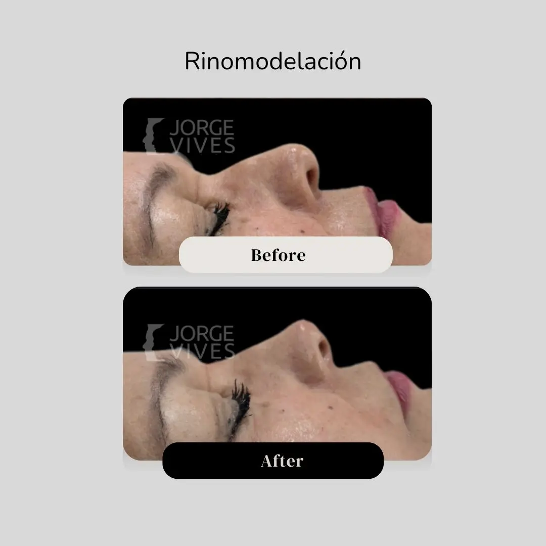 Rinomodelación en Cartagena - Casos de éxito - Dr. Jorge Vives