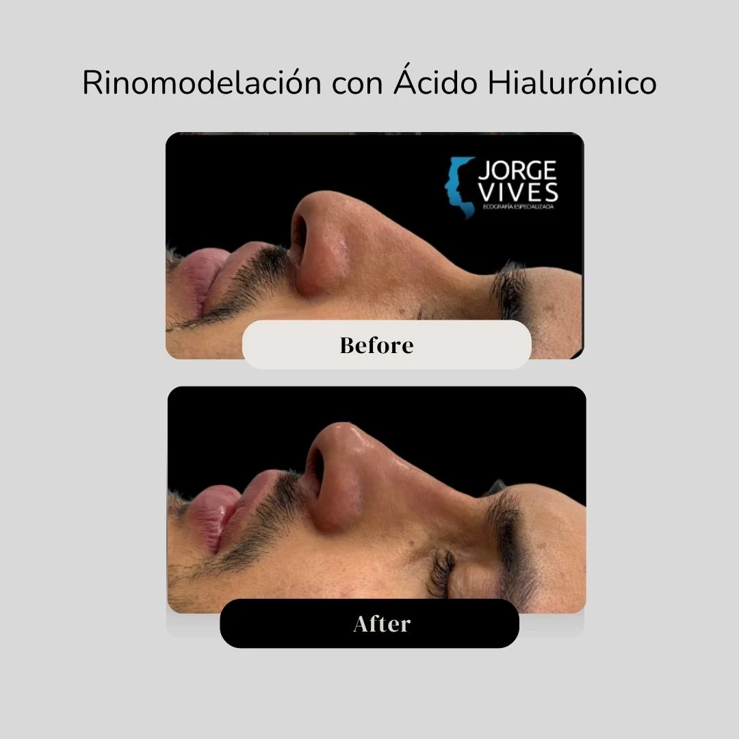 Antes y después de una rinomodelación en Cartagena - Dr. Vives
