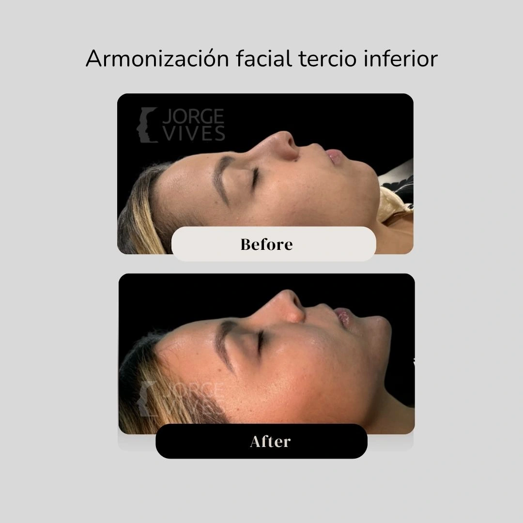 Armonización facial en Cartagena - Dr. Vives Cartagena