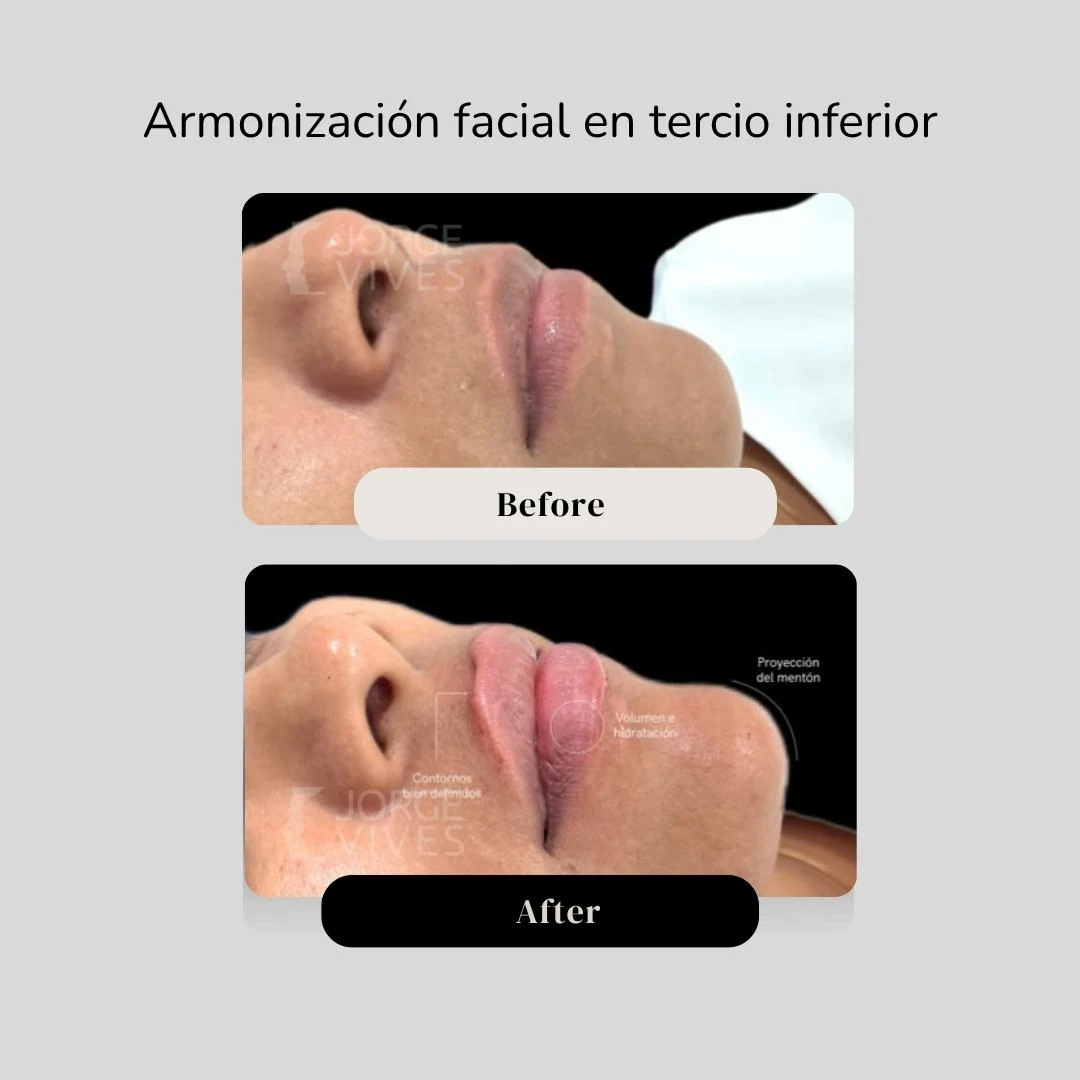 Armonización facial en Cartagena - Dr. Vives - Casos de éxito en Cartagena