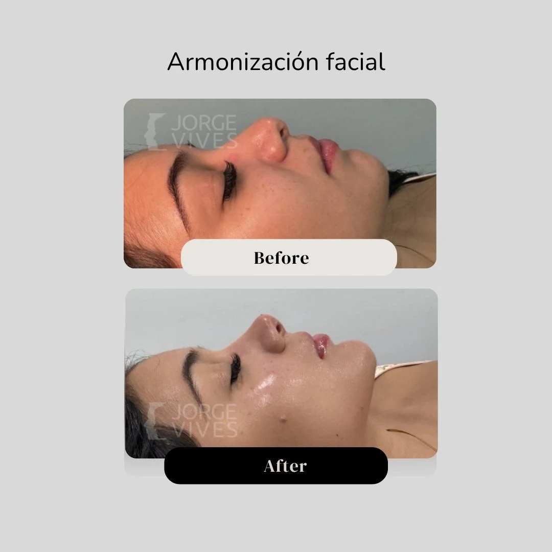 Armonización facial en Cartagena - Dr. Vives
