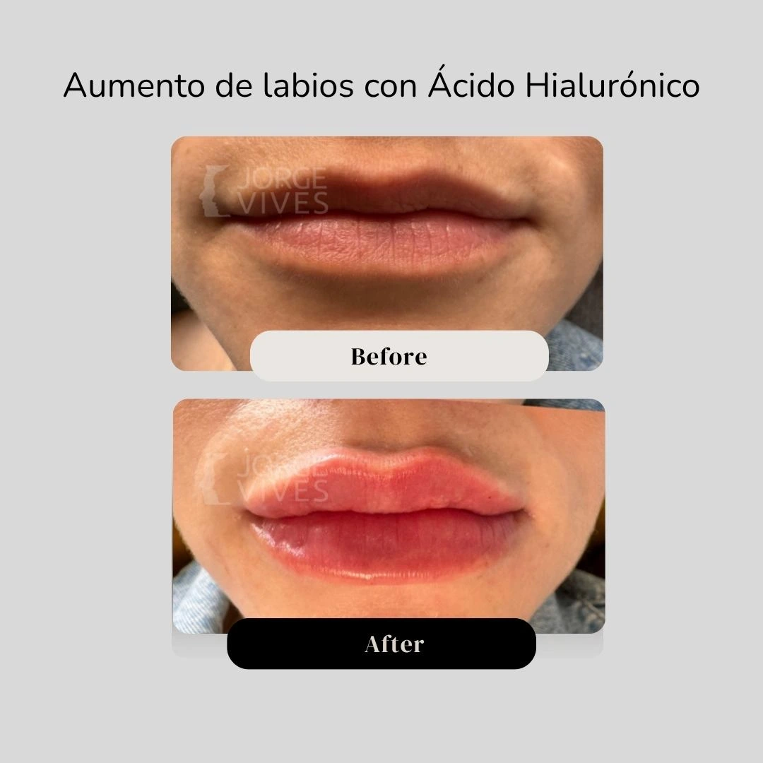 Aumento de labios con Á. H. en Cartagena - Dr. Jorge Vives