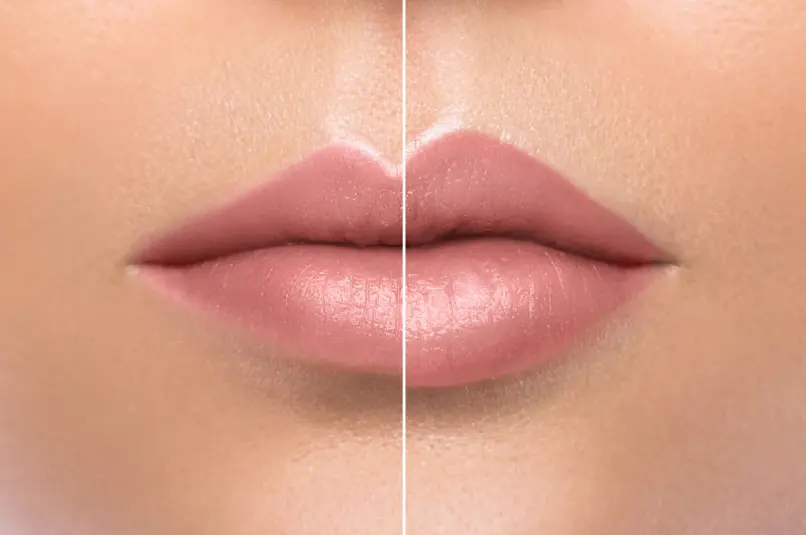 Aumento de labios en Cartagena- Dr. Jorge Vives- Radiologo