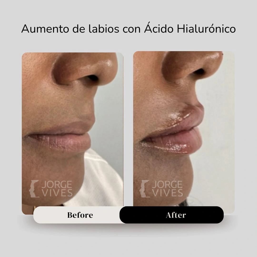 Aumento de labios en Cartagena - Dr. Jorge Vives