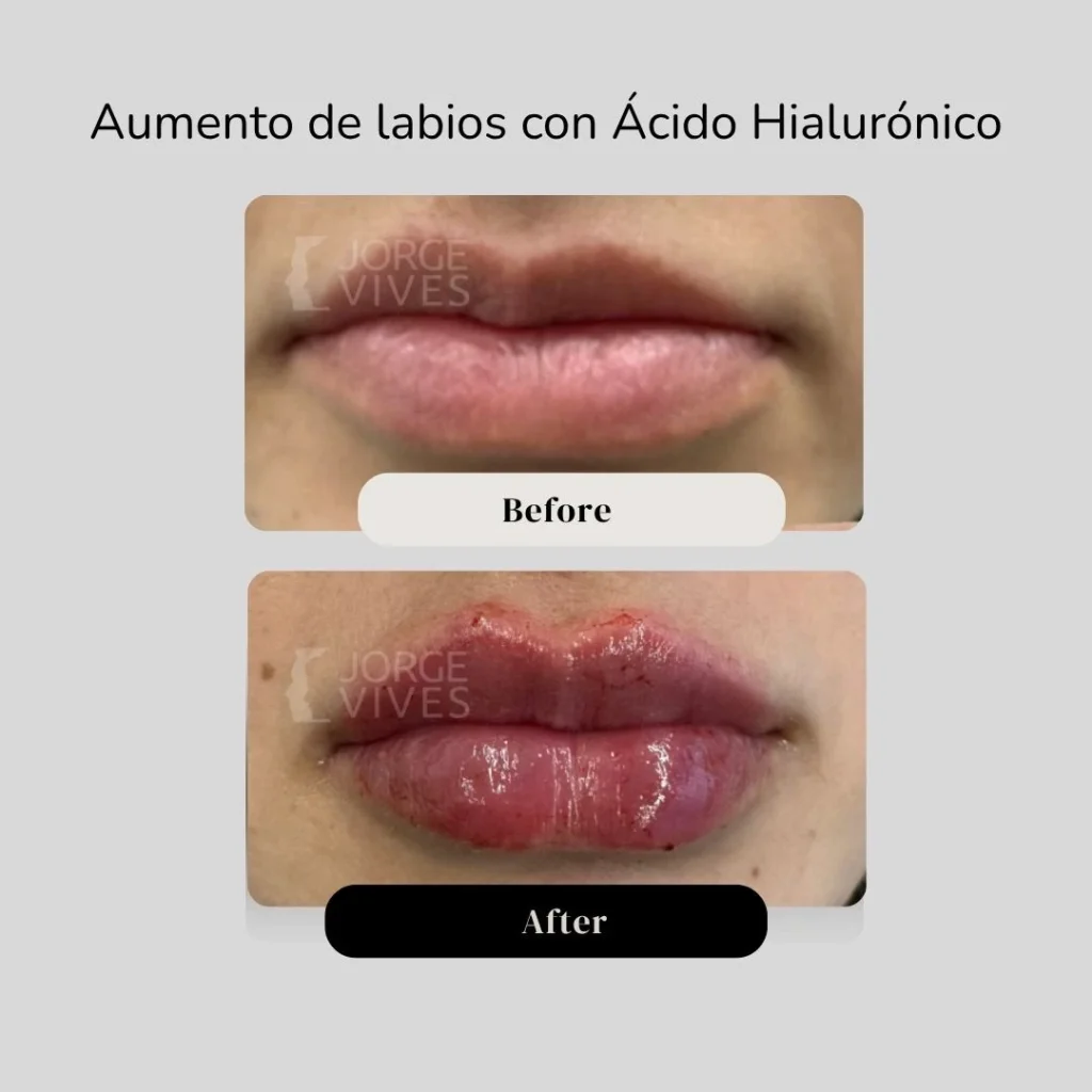 Aumento de labios en Cartagena - Dr. Vives