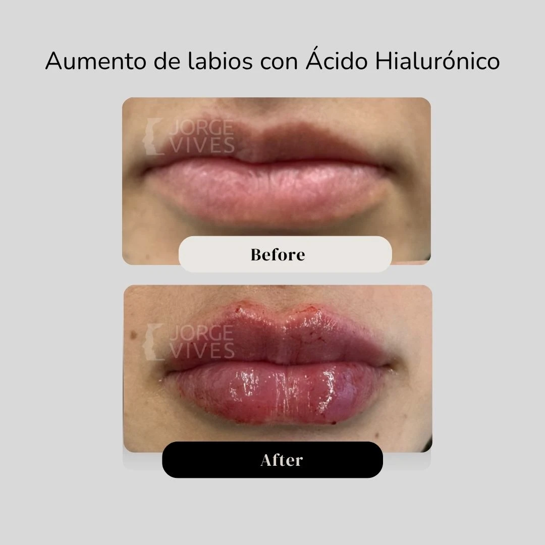 Aumento de labios en Cartagena - Dr. Vives
