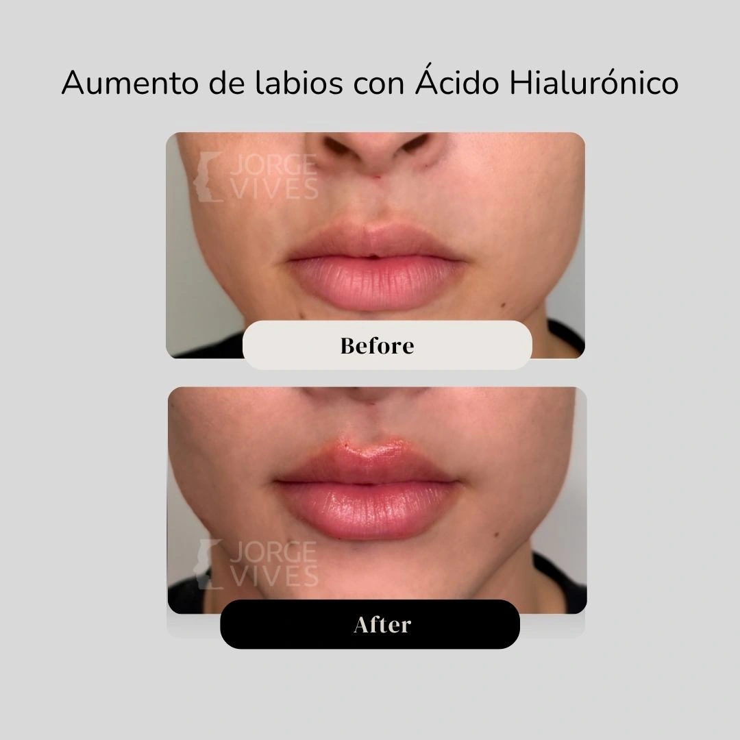 Aumento de labios en cartagena - Dr. Vives - casos