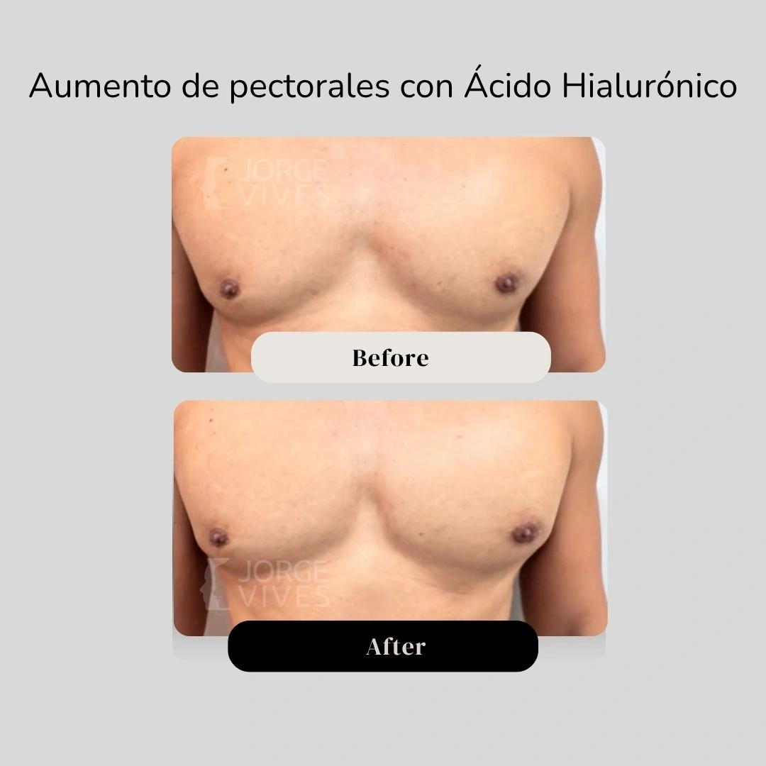 Aumento de pectorales con ácido hialurónico en Cartagena