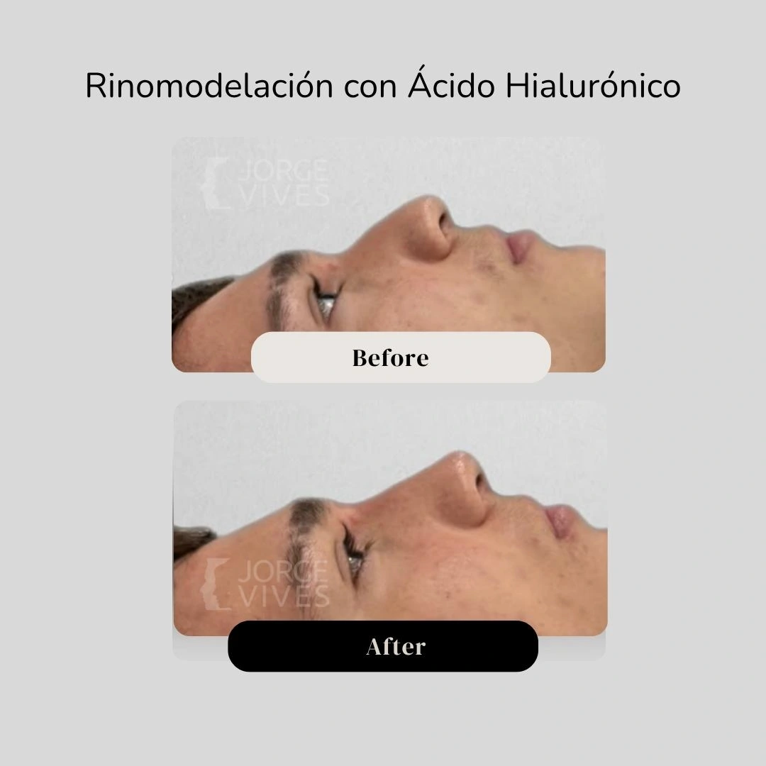 Rinomodelación en Cartagena - Casos de éxito - Dr. Jorge Vives