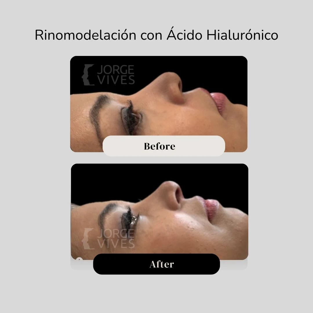 Rinomodelación en Cartagena con Ácido Hialurónico - Casos de éxito