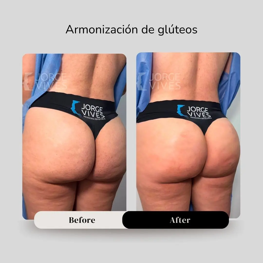 Gluteal contouring with hyaluronic acid and endolifting: before and after, by Dr. Jorge Vives, Cartagena, Colombia