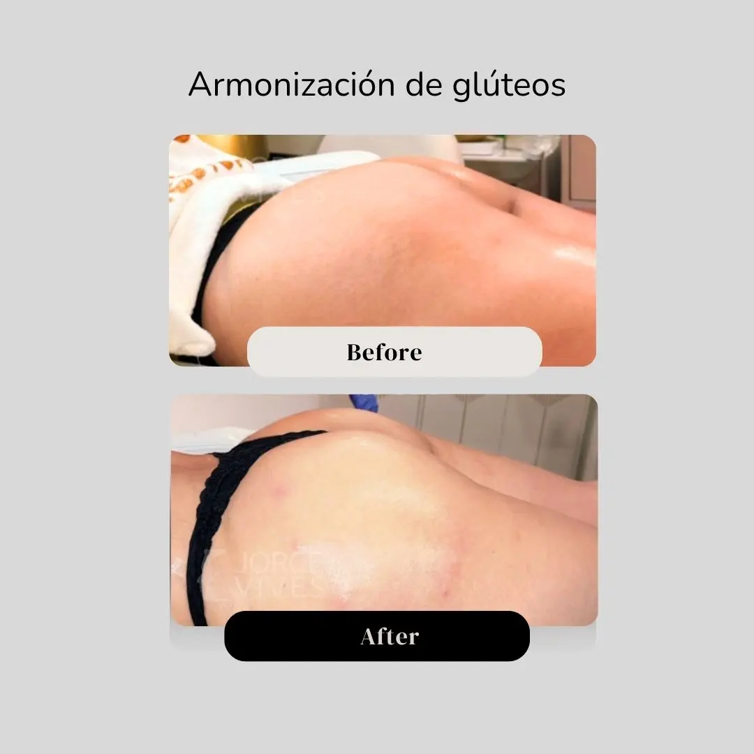 Ultrasound-guided gluteal contouring: before and after, by Dr. Jorge Vives, Cartagena, Colombia