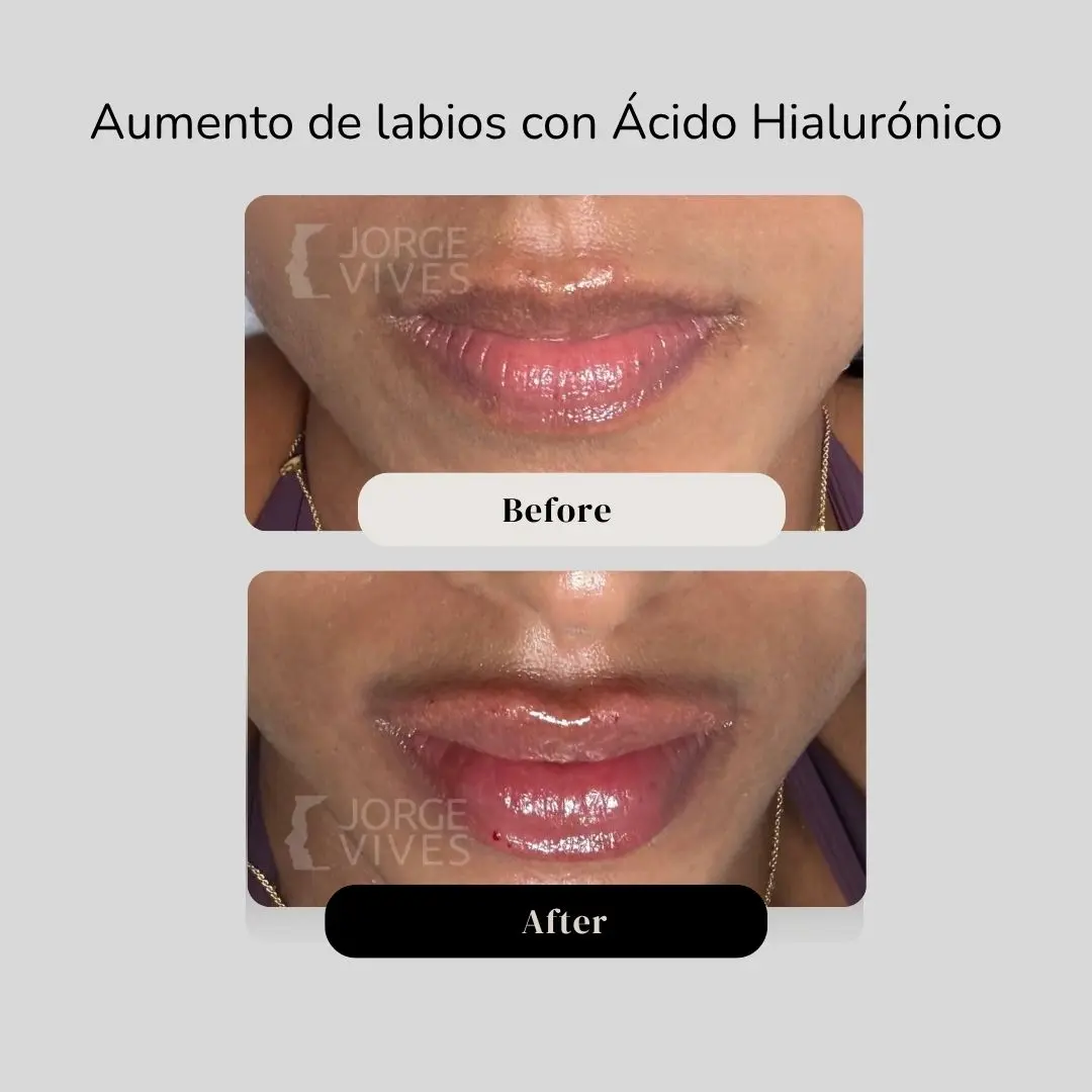 Aumento de labios con ácido hialurónico antes y después - Dr. Jorge Vives - Cartagena, Colombia - 080726 1