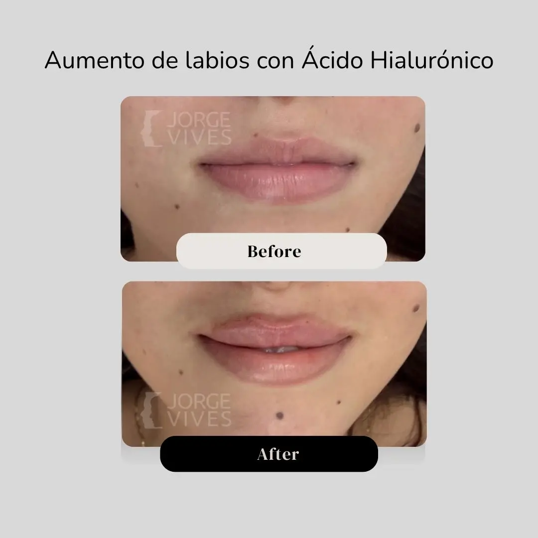 Aumento de labios con ácido hialurónico antes y después - Dr. Jorge Vives - Cartagena, Colombia - 080726