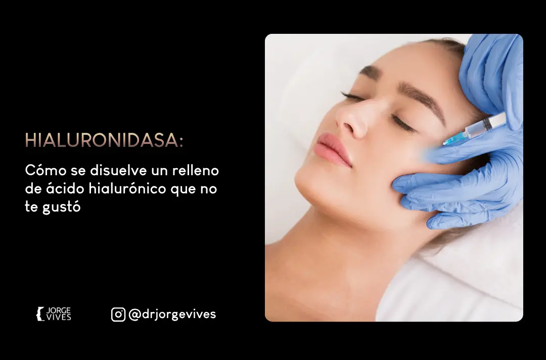 Hialuronidasa para corrección de rellenos faciales - Dr. Jorge Vives - Cartagena, Colombia