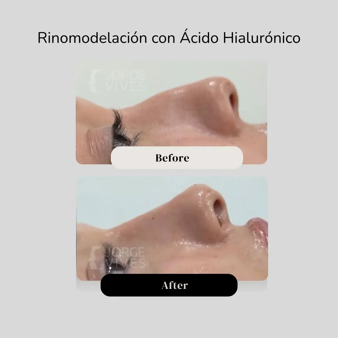 Rinomodelación con ácido hialurónico antes y después - Dr. Jorge Vives - Cartagena, Colombia - 080726