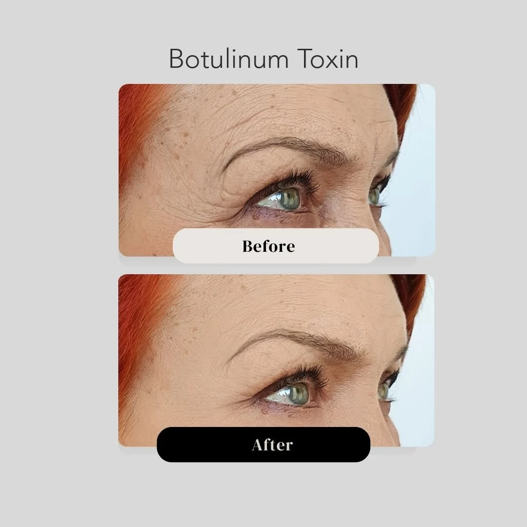 Botulinum toxin treatment before and after in Cartagena, Colombia