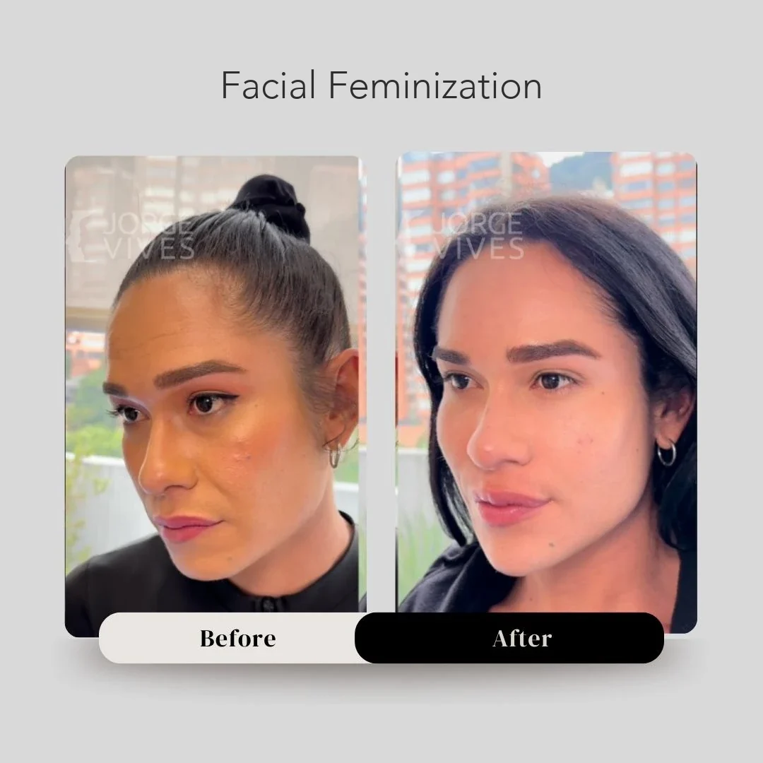 Facial feminization before and after, Cartagena, Colombia
