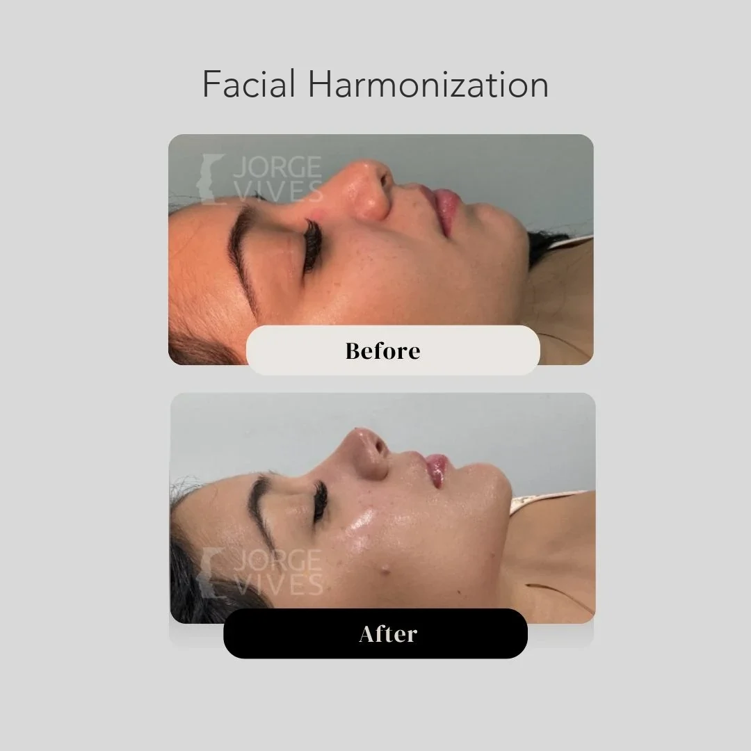 Facial harmonization before and after, ultrasound-guided filler in Cartagena, Colombia