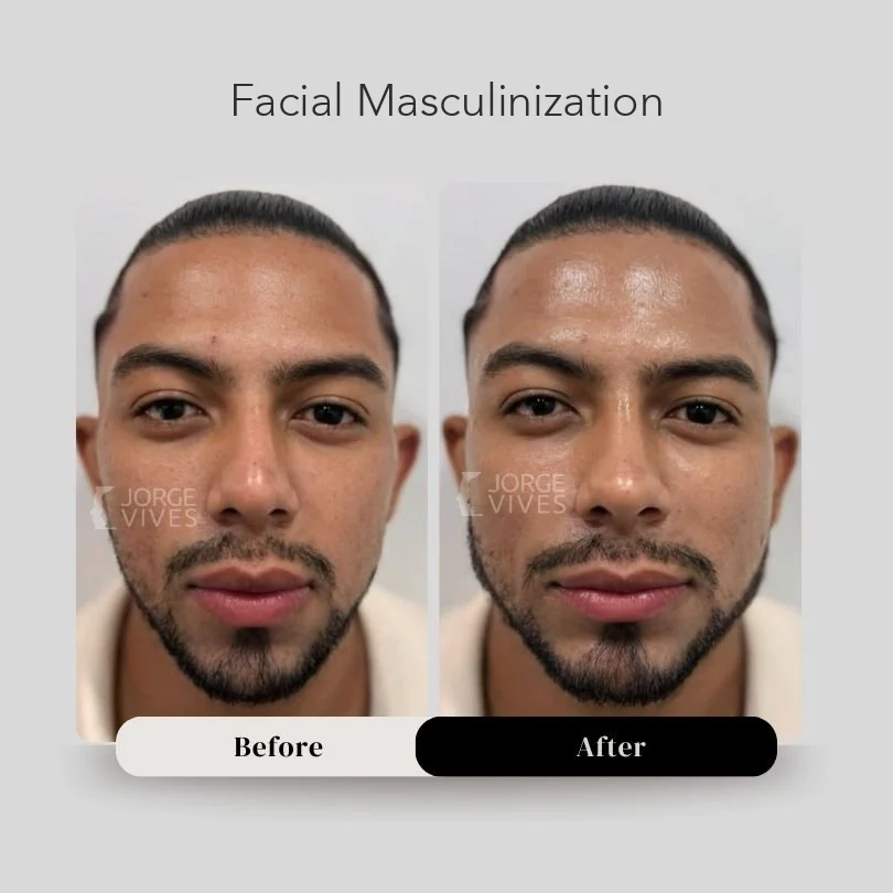 Facial masculinization before and after in Cartagena, Colombia