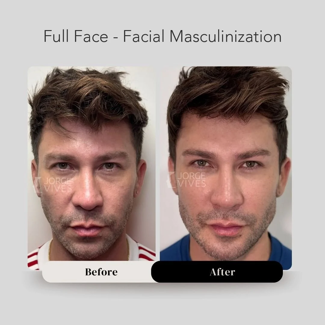 Full face facial masculinization before and after, Dr. Jorge Vives, Cartagena