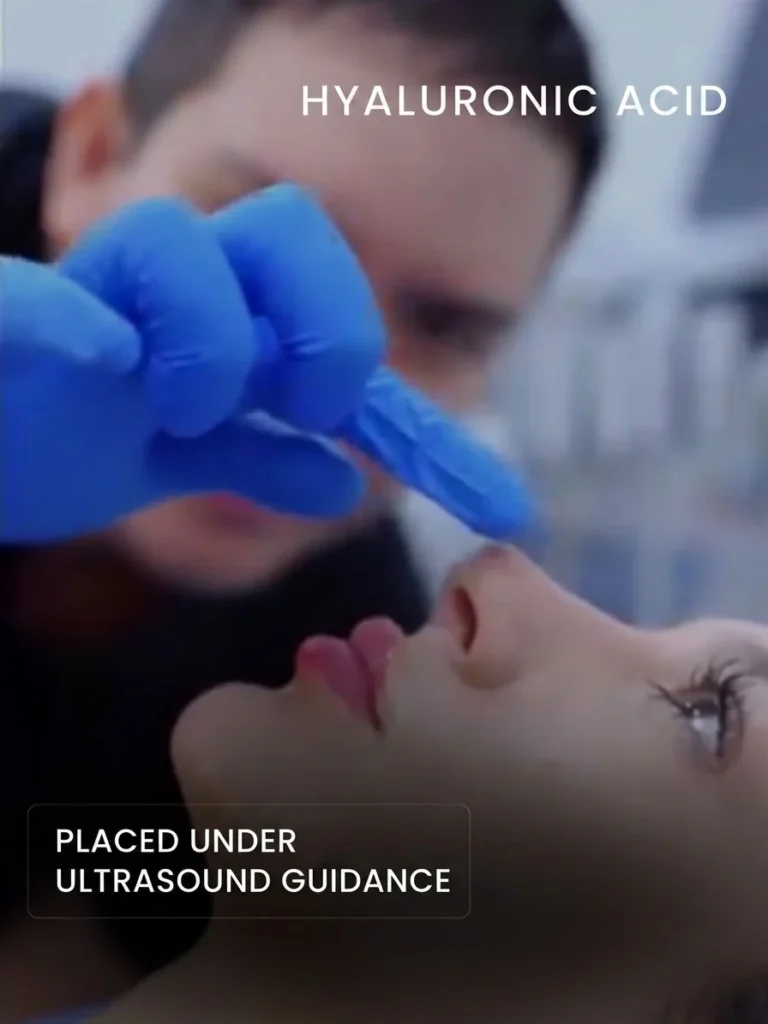 Hyaluronic acid filler placed under ultrasound guidance