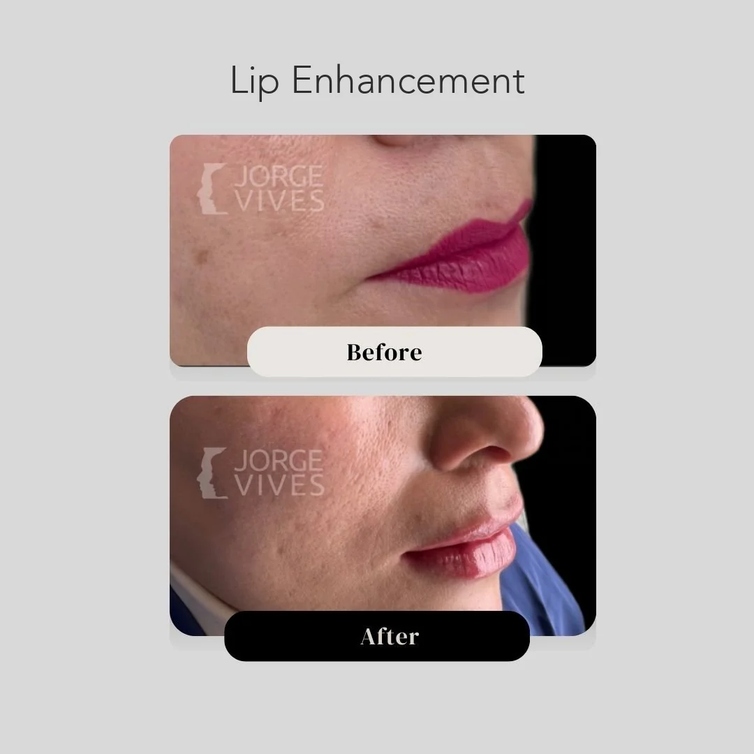 Lip enhancement before and after in Cartagena, Colombia