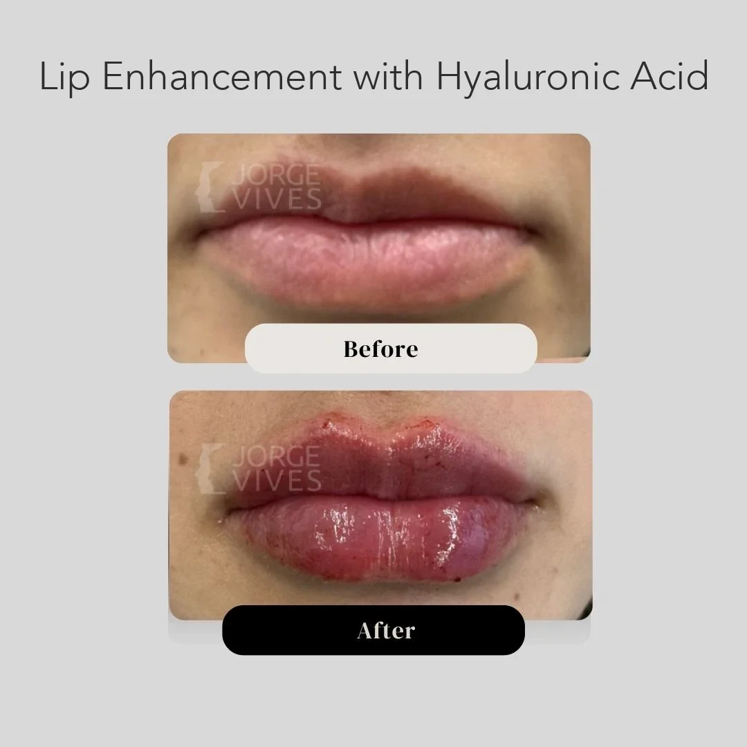 Lip enhancement with hyaluronic acid, before and after, Cartagena, Colombia