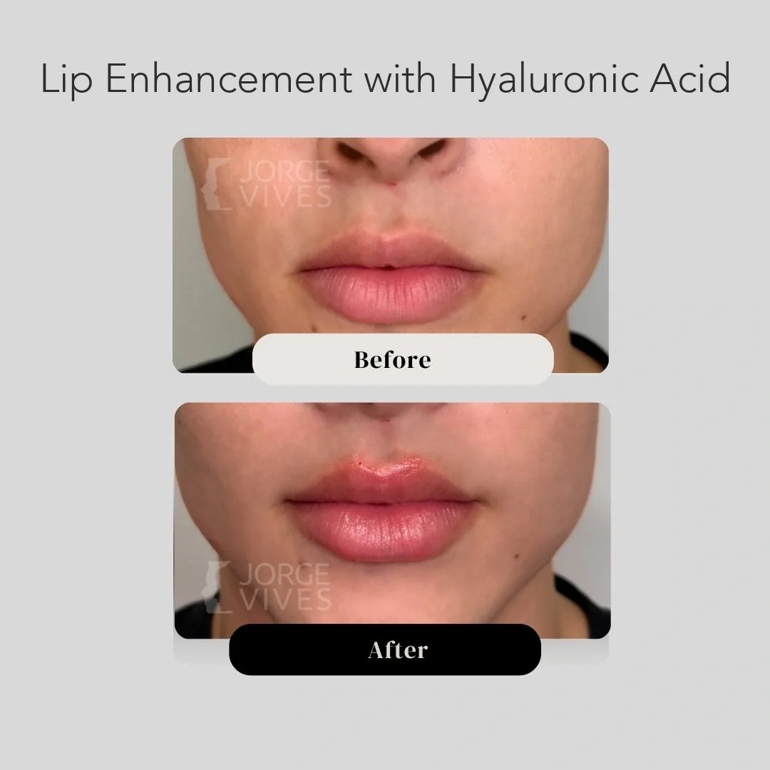 Lip enhancement with hyaluronic acid, patient case, Colombia