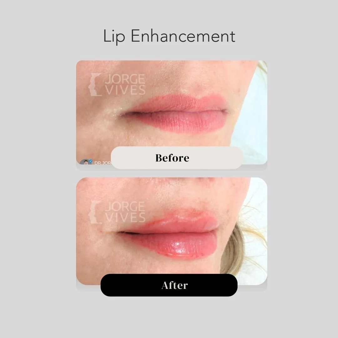 Lip filler before and after in Cartagena, Colombia