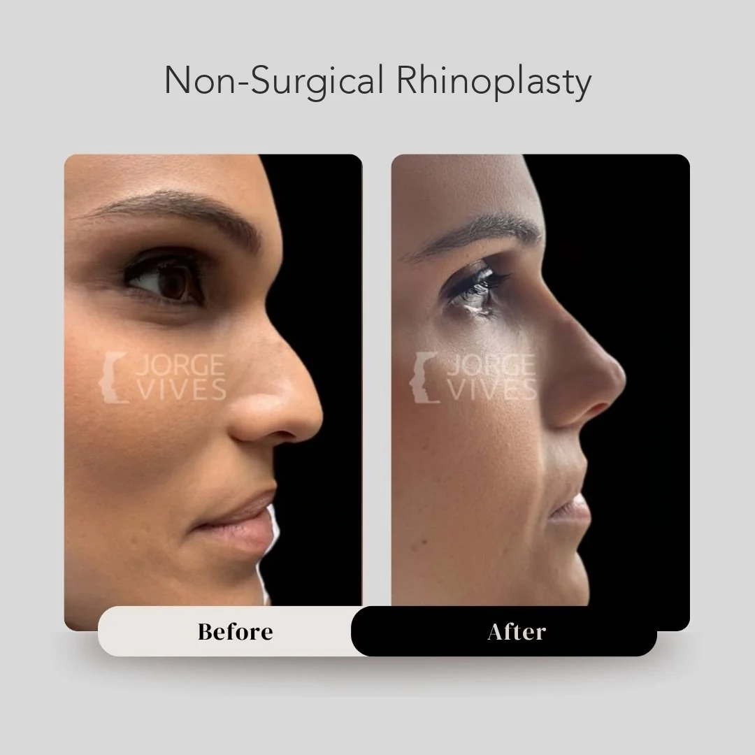 Non-surgical rhinoplasty before and after in Cartagena, Colombia