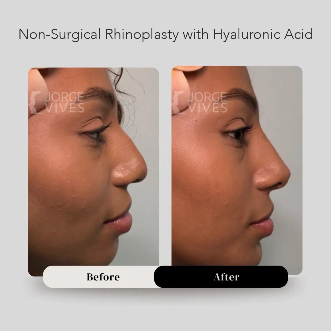 Non-surgical rhinoplasty with hyaluronic acid, results, Cartagena, Colombia