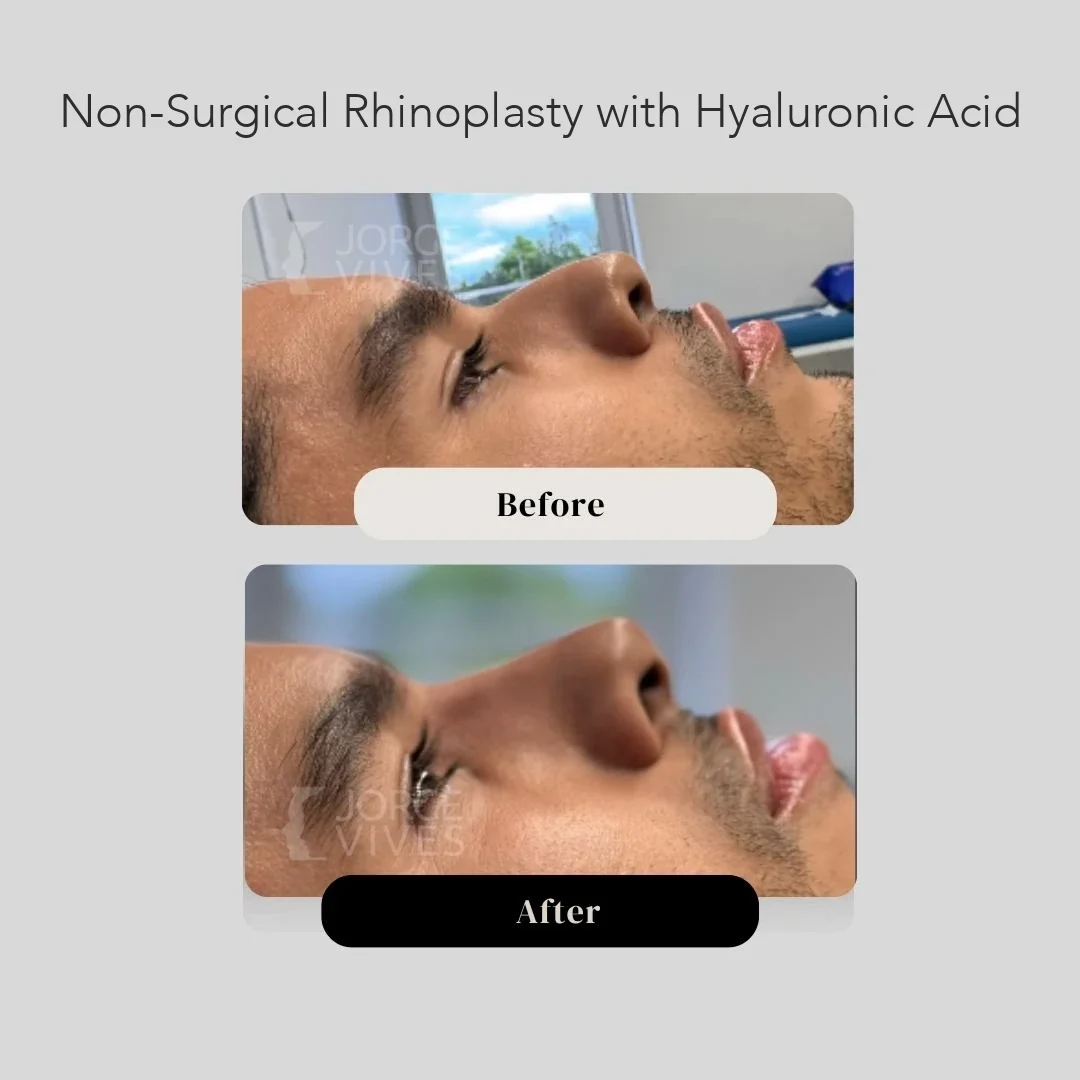 Non-surgical rhinoplasty with hyaluronic acid, patient cases, Colombia