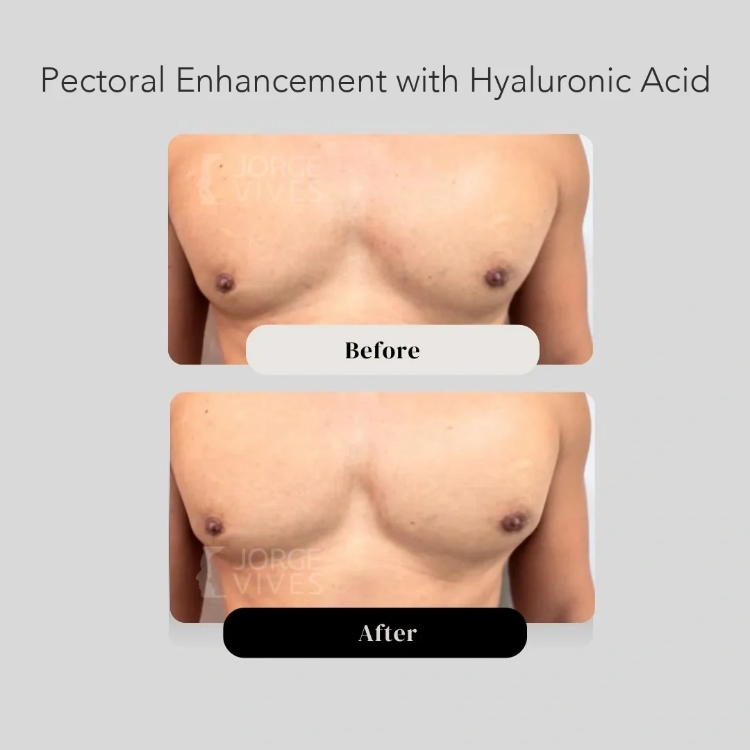 Pectoral enhancement with hyaluronic acid, before and after, Colombia