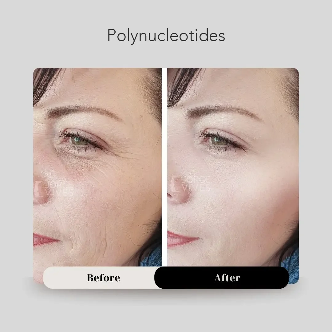 Polynucleotide treatment before and after, Dr. Jorge Vives, Cartagena, Colombia