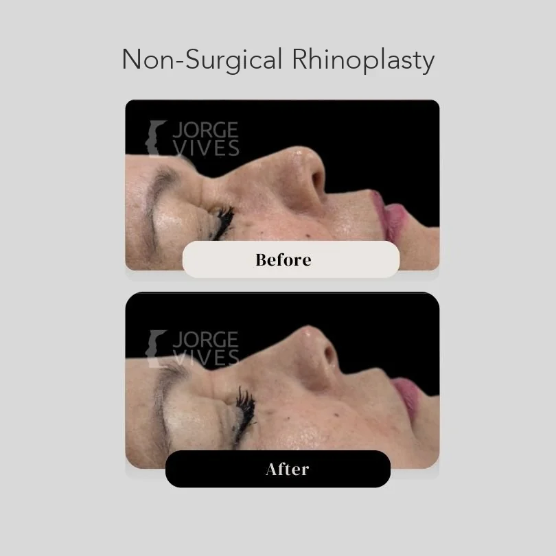 Ultrasound-guided non-surgical rhinoplasty before and after, Dr. Jorge Vives