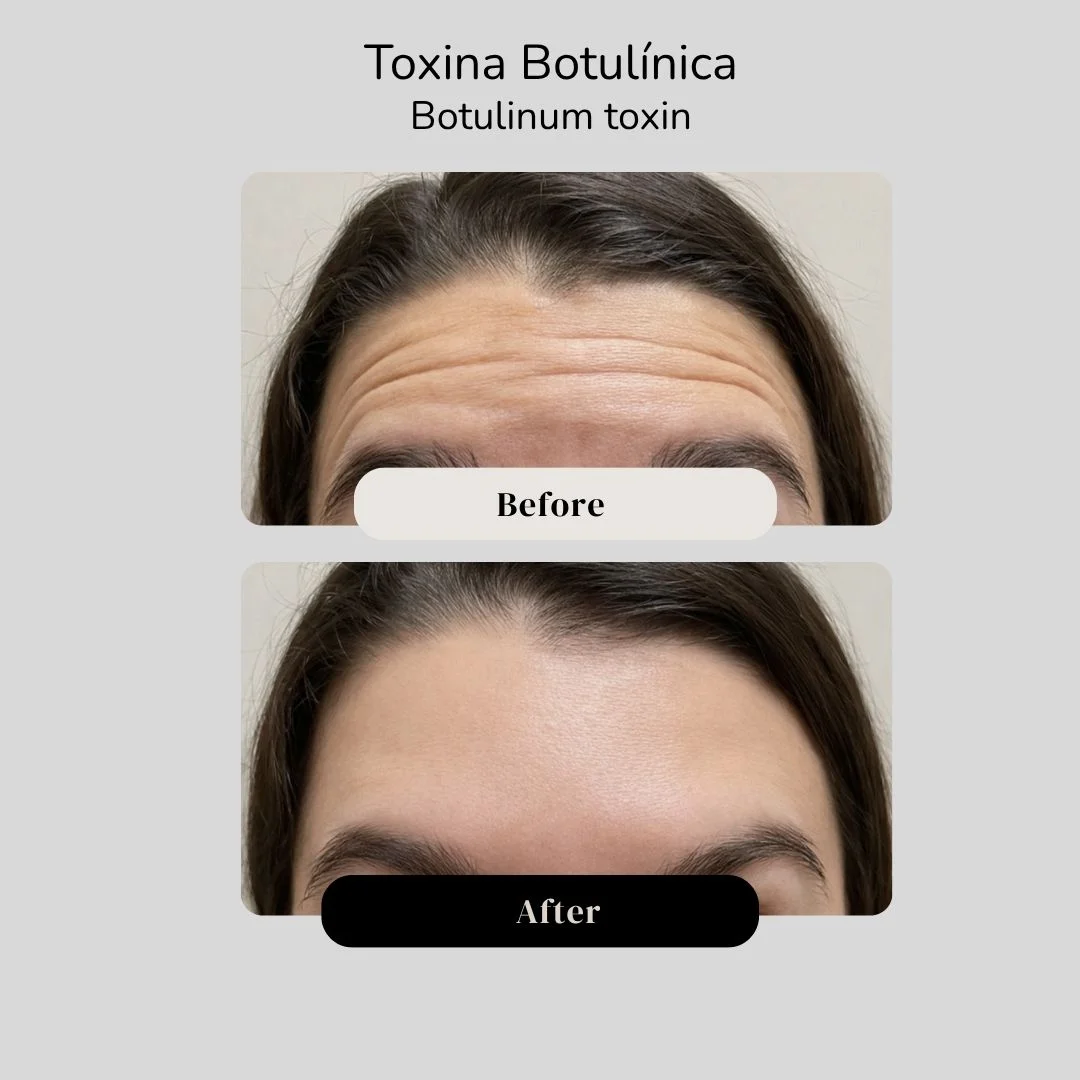 Botulinum toxin before and after - Dr. Jorge Vives - Cartagena, Colombia