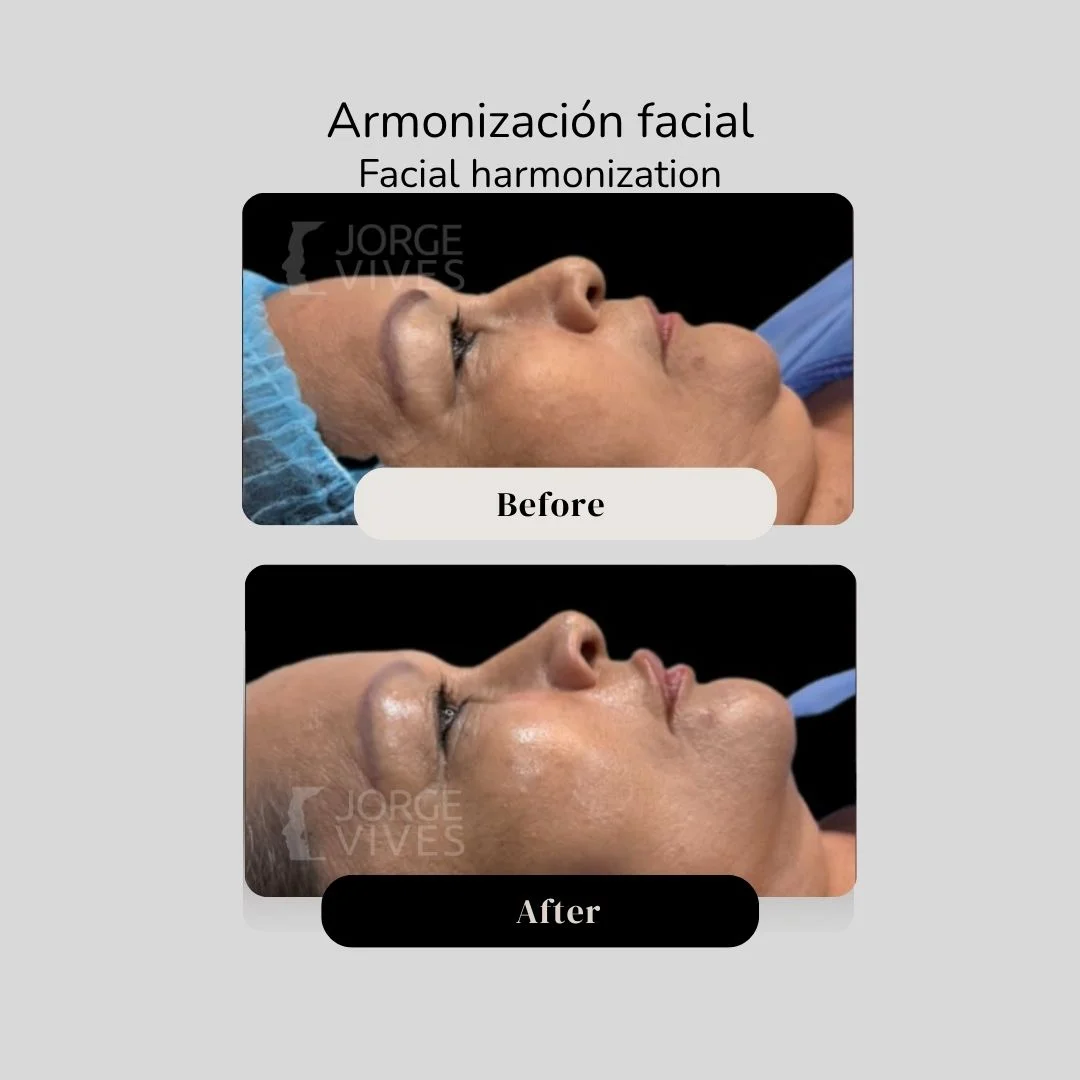 Facial harmonization before and after - Dr. Jorge Vives - Cartagena, Colombia 1