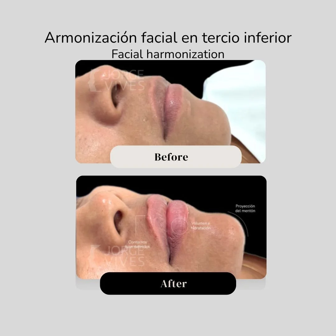 Facial harmonization before and after - Dr. Jorge Vives - Cartagena, Colombia 2