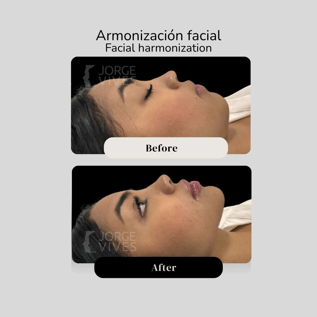 Facial harmonization before and after - Dr. Jorge Vives - Cartagena, Colombia 4