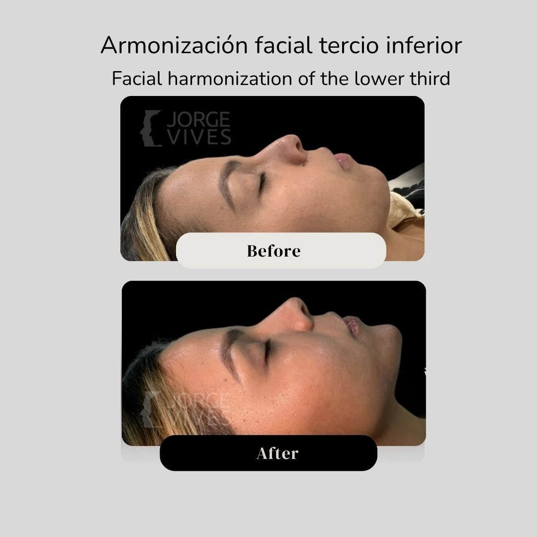 Facial harmonization before and after - Dr. Jorge Vives - Cartagena, Colombia 5