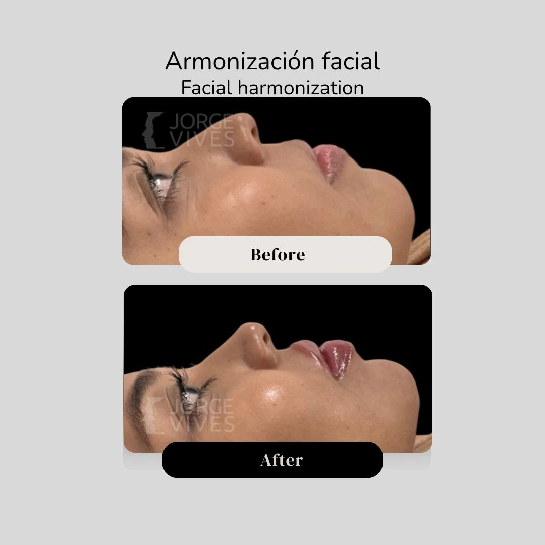 Facial harmonization before and after - Dr. Jorge Vives - Cartagena, Colombia 6