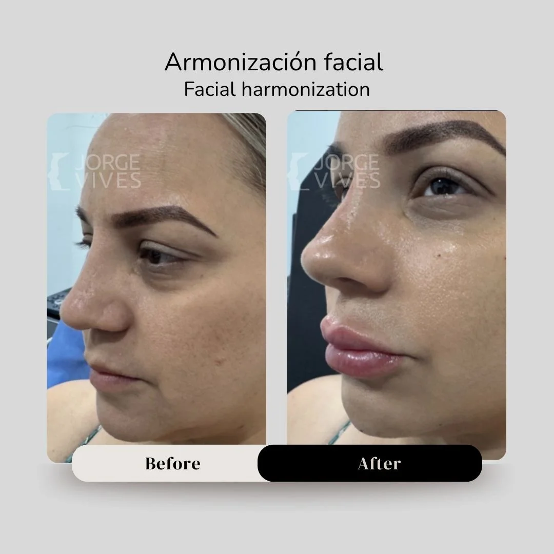 Facial harmonization before and after - Dr. Jorge Vives - Cartagena, Colombia