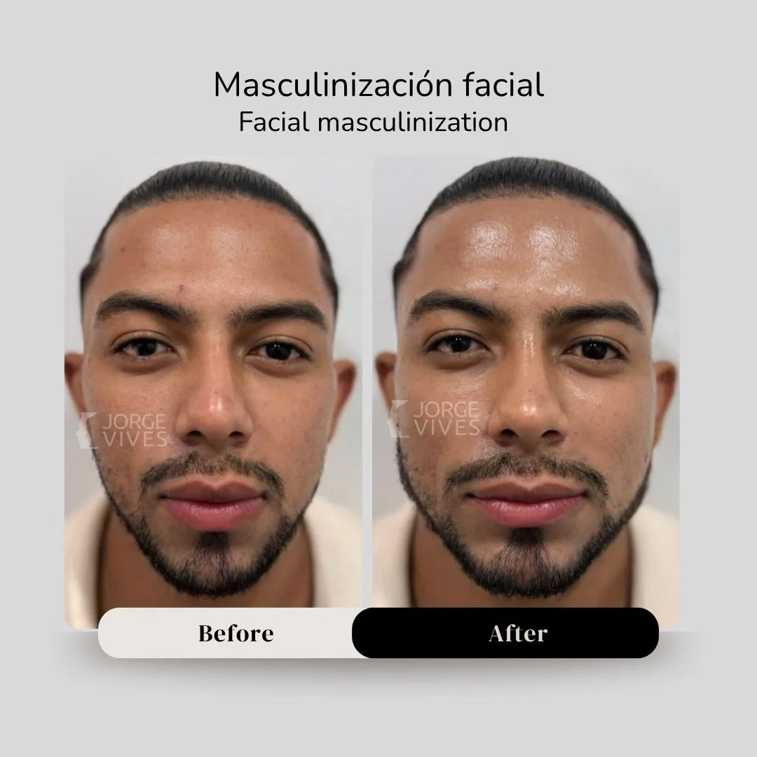 Facial masculinization before and after - Dr. Jorge Vives - Cartagena, Colombia 1